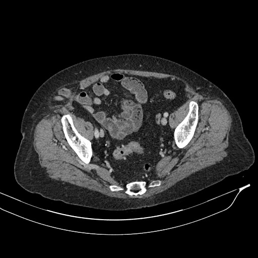 Calcified adrenal glands and Spigelian hernia (Radiopaedia 49741-54988 A 199).jpg