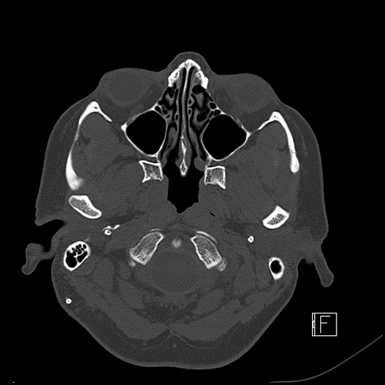 Calcified chronic subdural hematoma (Radiopaedia 77374-89492 Axial bone window 9).jpg