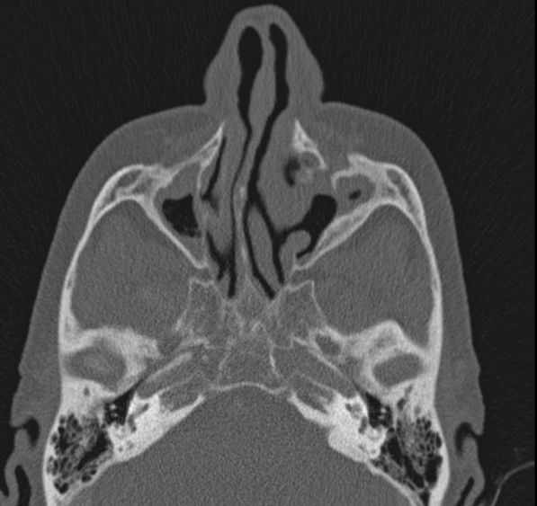 Caldwell-Luc operation (Radiopaedia 52329-58225 Axial bone window 34).jpg