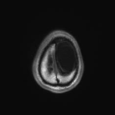 Callosal dysgenesis with interhemispheric cyst (Radiopaedia 53355-59335 Axial T1 149).jpg
