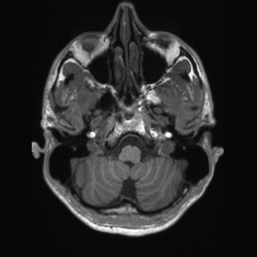 Callosal dysgenesis with interhemispheric cyst (Radiopaedia 53355-59335 Axial T1 26).jpg