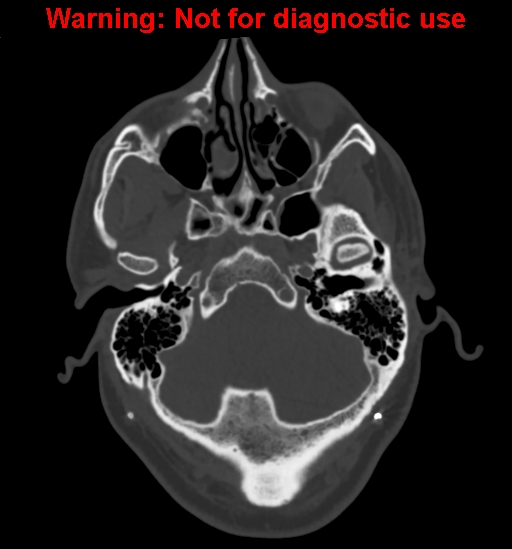 Calvarial thickening from chronic shunting (Radiopaedia 60079-67637 Axial bone window 29).jpg