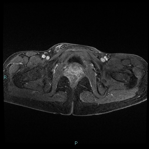 File:Canal of Nuck cyst (Radiopaedia 55074-61448 Axial T1 C+ fat sat 46).jpg