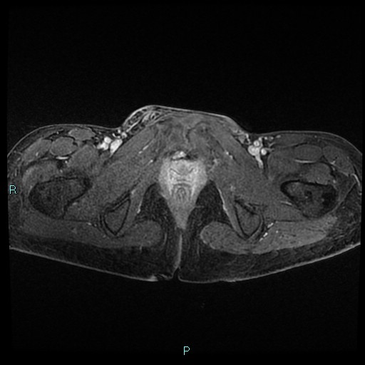 File:Canal of Nuck cyst (Radiopaedia 55074-61448 Axial T1 C+ fat sat 50).jpg