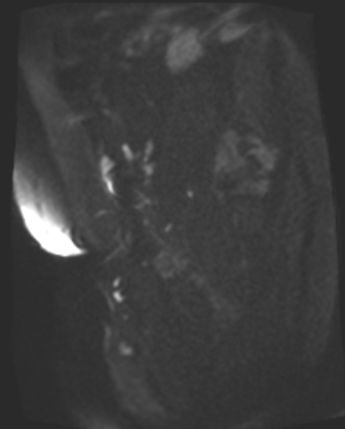 Cancer cervix - stage IIb (Radiopaedia 75411-86615 Sagittal DWI 70).jpg