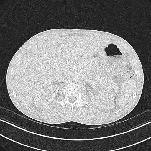 Cannonball metastases - testicular choriocarcinoma (Radiopaedia 84510-99891 Axial lung window 100).jpg