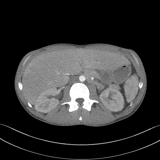 Cannonball metastases - testicular choriocarcinoma (Radiopaedia 84510-99891 B 120).jpg
