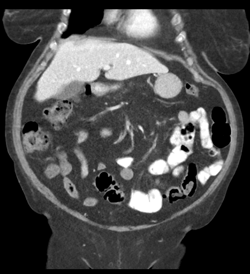 Cannonball metastases from endometrial cancer (Radiopaedia 42003-45031 F 25).png