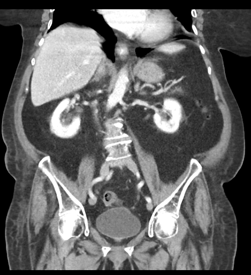 File:Cannonball metastases from endometrial cancer (Radiopaedia 42003-45031 F 39).png