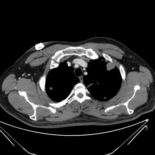 File:Cannonball pulmonary metastases (Radiopaedia 67684-77101 D 54).jpg