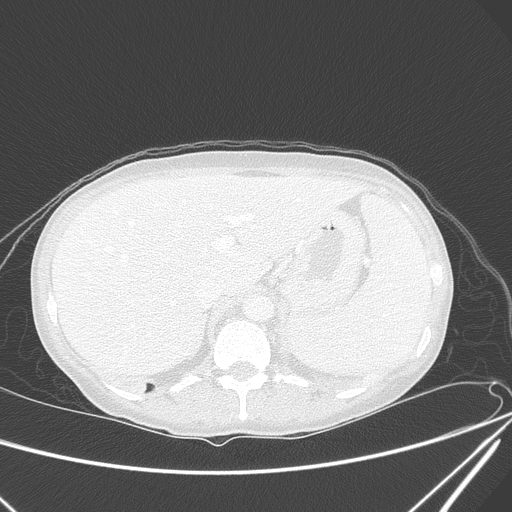 Canonball lung metastasis (Radiopaedia 77634-89837 Axial lung window 175).jpg