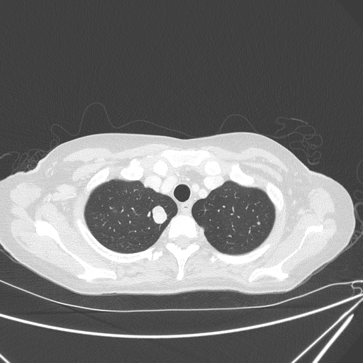 Canonball lung metastasis (Radiopaedia 77634-89837 Axial lung window 29).jpg