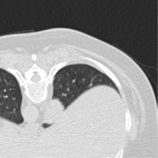 File:Carcinoid tumor - lung (Radiopaedia 44814-48644 Axial lung window 17).png