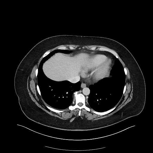 File:Carcinoid tumor - terminal ileum (Radiopaedia 60931-68739 Axial 115).jpg