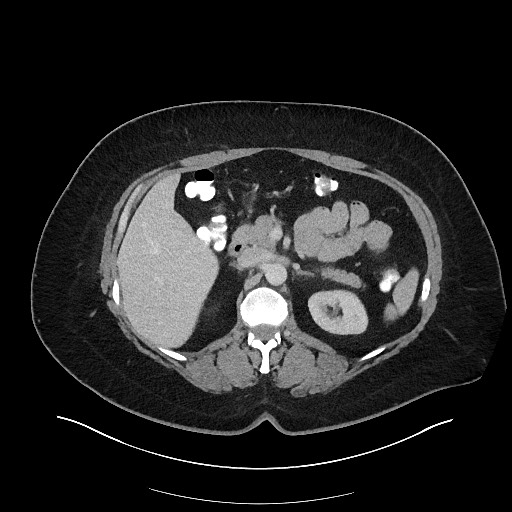 File:Carcinoid tumor - terminal ileum (Radiopaedia 60931-68739 Axial 49).jpg