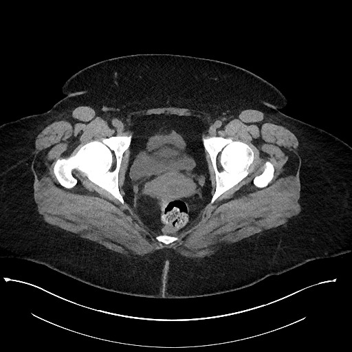 Carcinoid tumor - terminal ileum (Radiopaedia 60931-68740 Axial non-contrast 119).jpg
