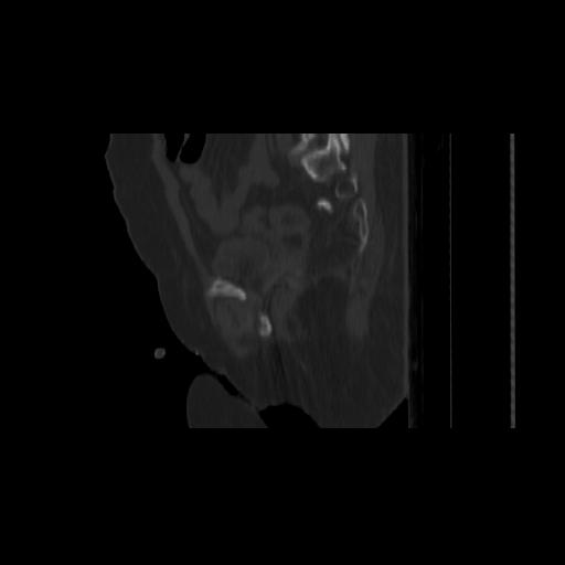 Carcinoma cervix- brachytherapy applicator (Radiopaedia 33135-34173 Sagittal bone window 119).jpg