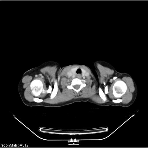 File:Carcinoma of esophagus (Radiopaedia 27356-27550 A 33).jpg