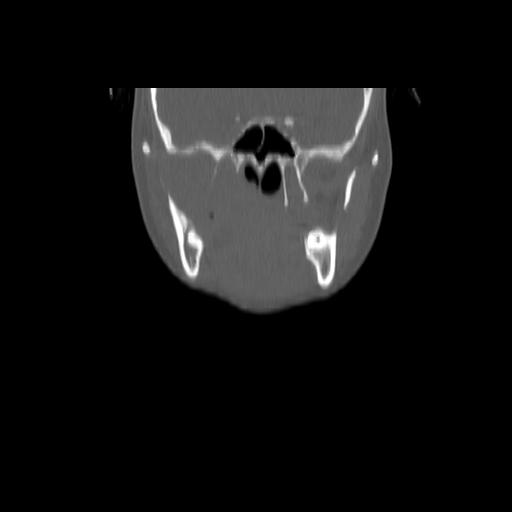 Carcinoma of the maxillary antrum (Radiopaedia 53805-59888 Coronal bone window 60).jpg