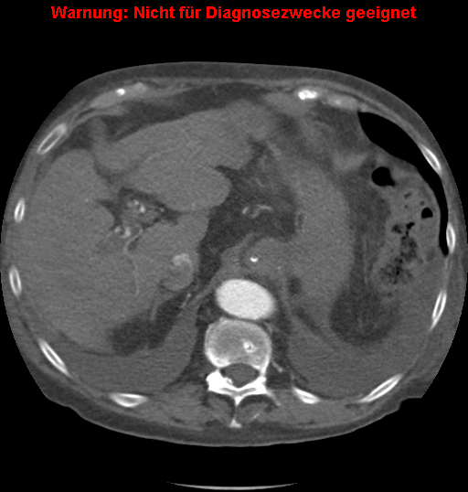 File:Cardiac perforation following transcatheter aortic valve implantation (Radiopaedia 23714-23863 A 20).png