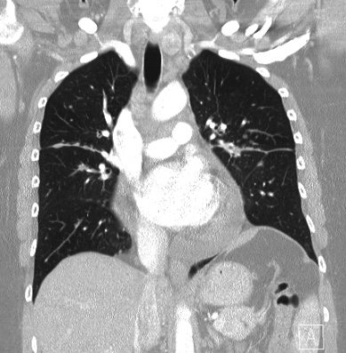 Cardiac sarcoidosis (Radiopaedia 74548-85534 Coronal lung window 32).jpg