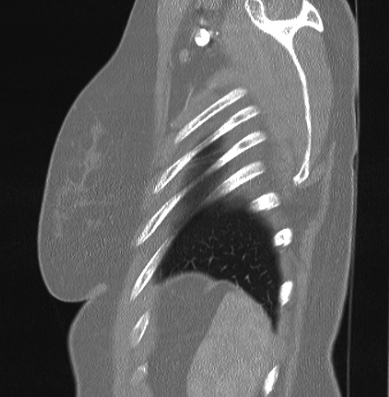Cardiac sarcoidosis (Radiopaedia 74548-85534 Sagittal lung window 7).jpg