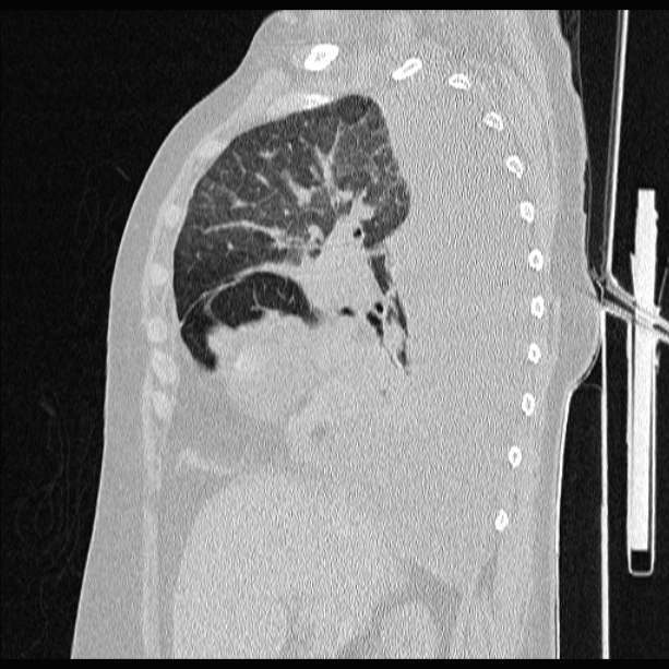 Cardiogenic pulmonary edema (Radiopaedia 29213-29609 Sagittal lung window 35).jpg
