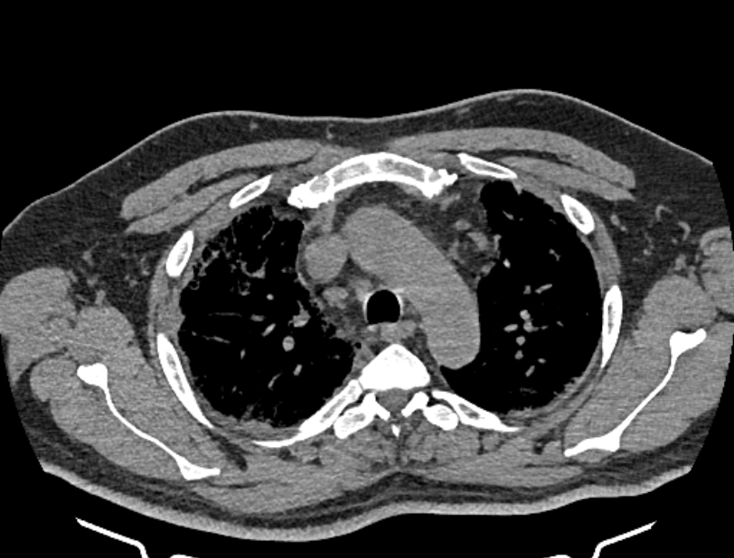 Cardiogenic pulmonary edema (Radiopaedia 68180-77678 Axial non-contrast 11).jpg