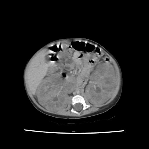 Caroli disease with autosomal recessive polycystic kidney disease (ARPKD) (Radiopaedia 89651-106703 B 119).jpg