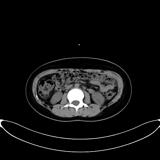 Caroli disease with medullary sponge kidney (Radiopaedia 82622-96804 Axial non-contrast 34).jpg