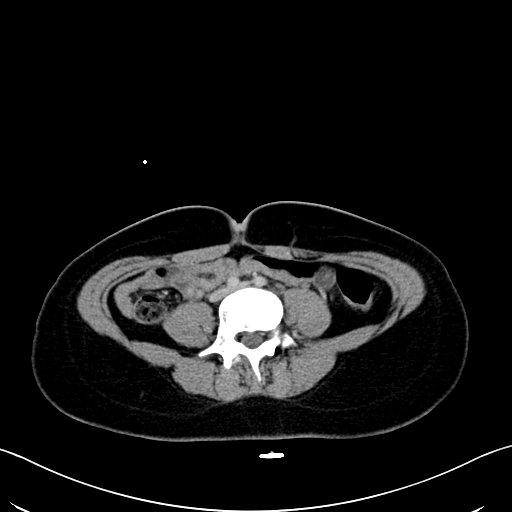 Caroli disease with medullary sponge kidney (Radiopaedia 82622-96804 C 46).jpg