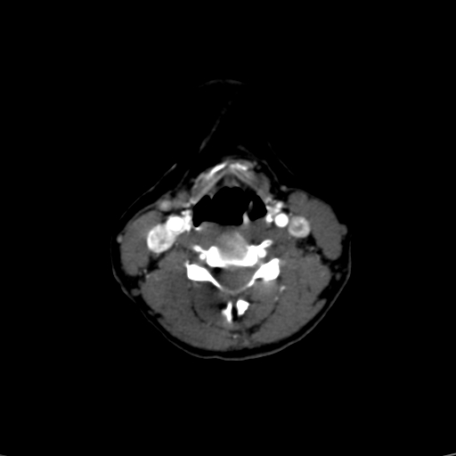 File:Carotid body tumor (Radiopaedia 39845-42300 B 22).jpg