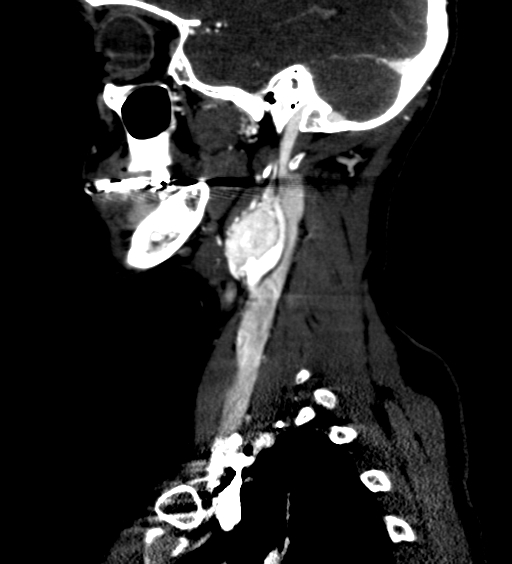 File:Carotid body tumor (Radiopaedia 39845-42300 D 19).jpg
