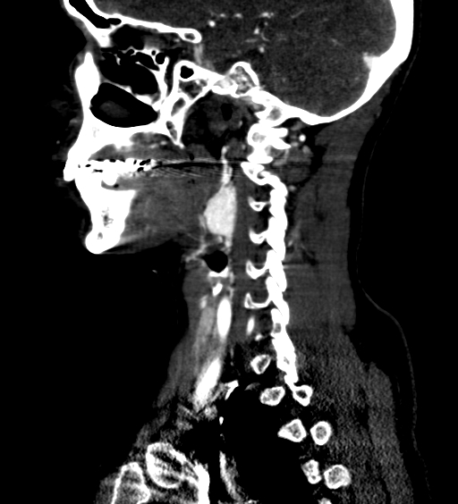 File:Carotid body tumor (Radiopaedia 39845-42300 D 51).jpg