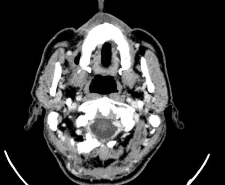 Carotid body tumor (Radiopaedia 61750-69757 Axial Post contrast 7).jpg