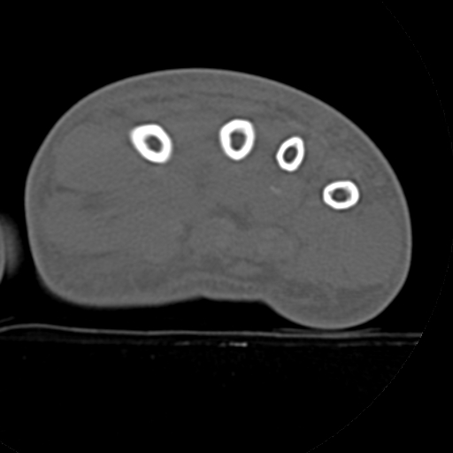 File:Carpo-metacarpal fracture-dislocations with hamatum split fracture (Radiopaedia 18482-18343 Axial bone window 7).jpg