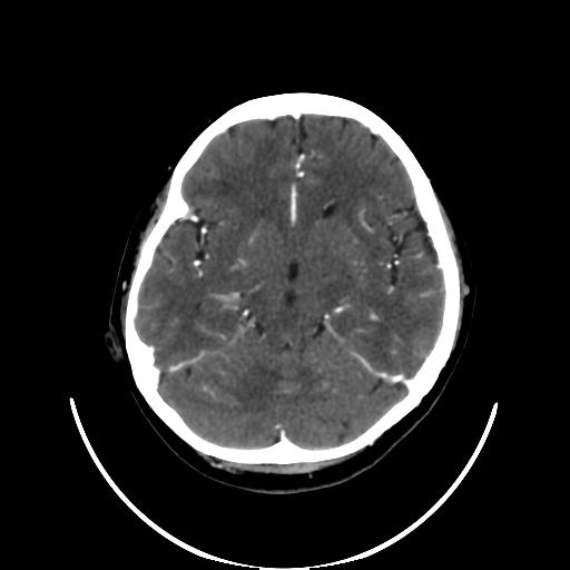 File:Cavernoma with developmental venous anomaly (Radiopaedia 22470-22506 C+ arterial phase 16).jpg