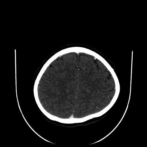 Cavernoma with developmental venous anomaly (Radiopaedia 22470-22506 C 148).jpg