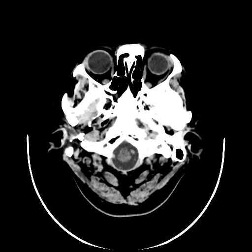 File:Cavernoma with developmental venous anomaly (Radiopaedia 22470-22506 non-contrast 1).jpg