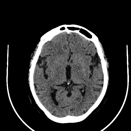 Cavernous hemangioma of the cerebellar falx (Radiopaedia 73025-83723 Axial non-contrast 67).jpg