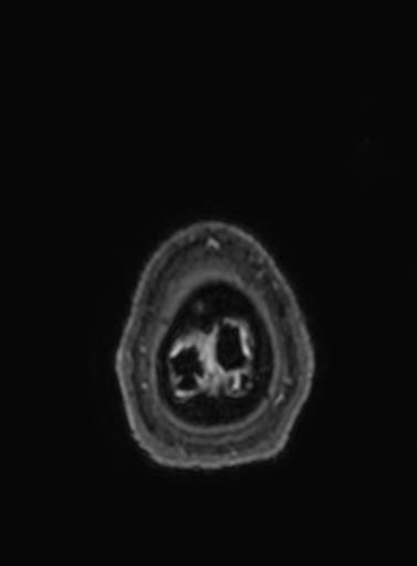 File:Cavernous hemangioma of the cerebellar falx (Radiopaedia 73025-83724 Axial T1 C+ 14).jpg