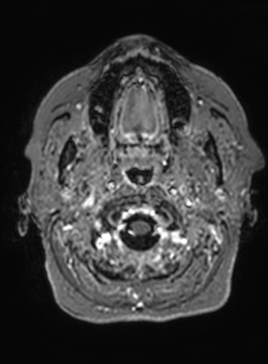 Cavernous hemangioma of the cerebellar falx (Radiopaedia 73025-83724 Axial T1 C+ 330).jpg