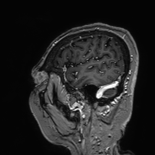 Cavernous hemangioma of the cerebellar falx (Radiopaedia 73025-83724 Sagittal T1 C+ 33).jpg