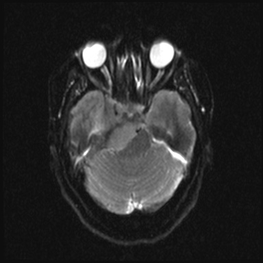 File:Cavernous sinus meningioma (Radiopaedia 63682-72367 DWI 8).jpg