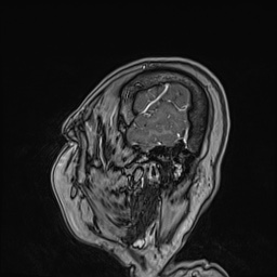 Cavernous sinus meningioma (Radiopaedia 63682-72367 Sagittal T1 C+ 33).jpg
