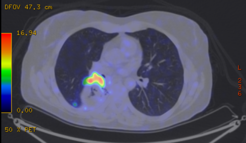 File:Cavitating lung mass - squamous cell carcinoma (Radiopaedia 48047-52853 A 48).png