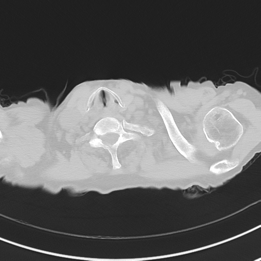 Cavitating pneumonia - lingular segments (Radiopaedia 34386-35678 Axial lung window 2).png