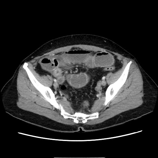 Cecal adenocarcinoma (Radiopaedia 75909-87331 A 72).jpg