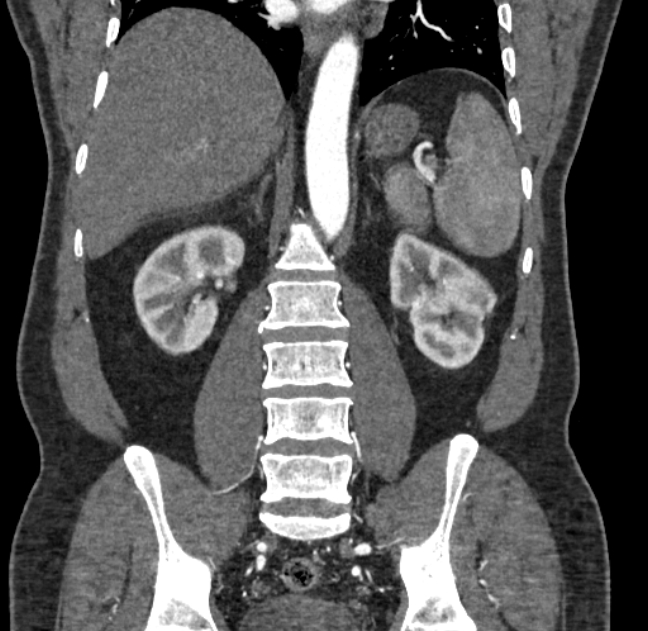 Celiac artery dissection (Radiopaedia 52194-58080 C 98).jpg