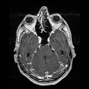 Central-variant posterior reversible encephalopathy syndrome (PRES) (Radiopaedia 43880-47358 Axial T1 C+ 43).jpg